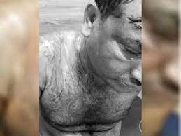 बदमाशों ने मारपीट कर खौलता हुआ तेल दिया