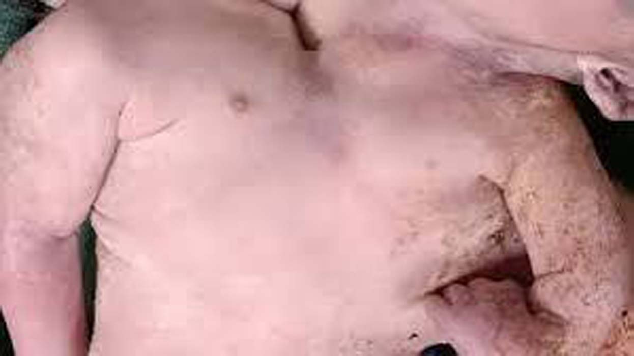 anuppur, One heart beating , two twins